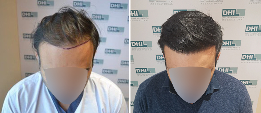 DHI before & after hair transplant results